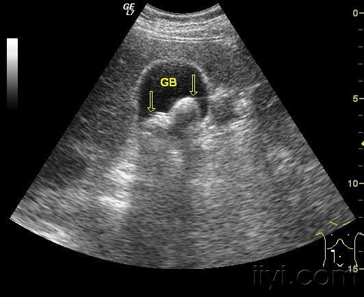胆总管结石彩超图片图片