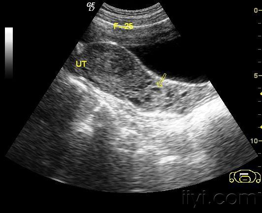 葡萄胎! - 超声医学讨论版 - 爱爱医医学论坛