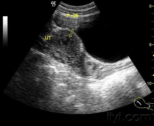 葡萄胎 超声医学讨论版 爱爱医医学论坛