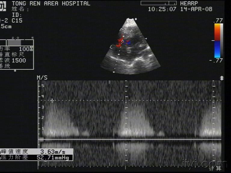 动脉导管未闭合并室缺 超声医学讨论版 爱爱医医学论坛