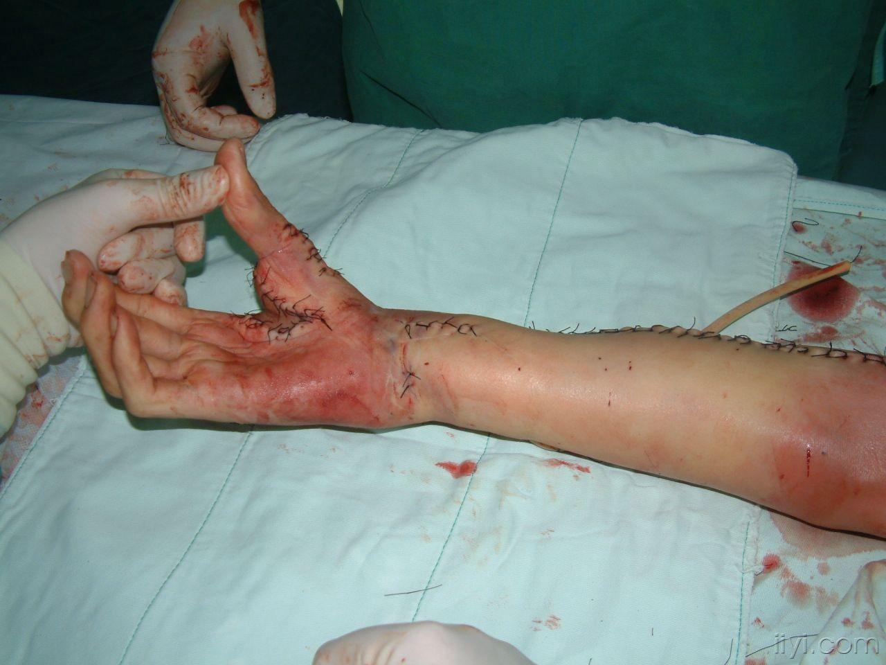 前臂外侧神经皮瓣大家学习