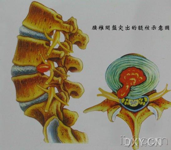 腰椎间盘突出症详解图解