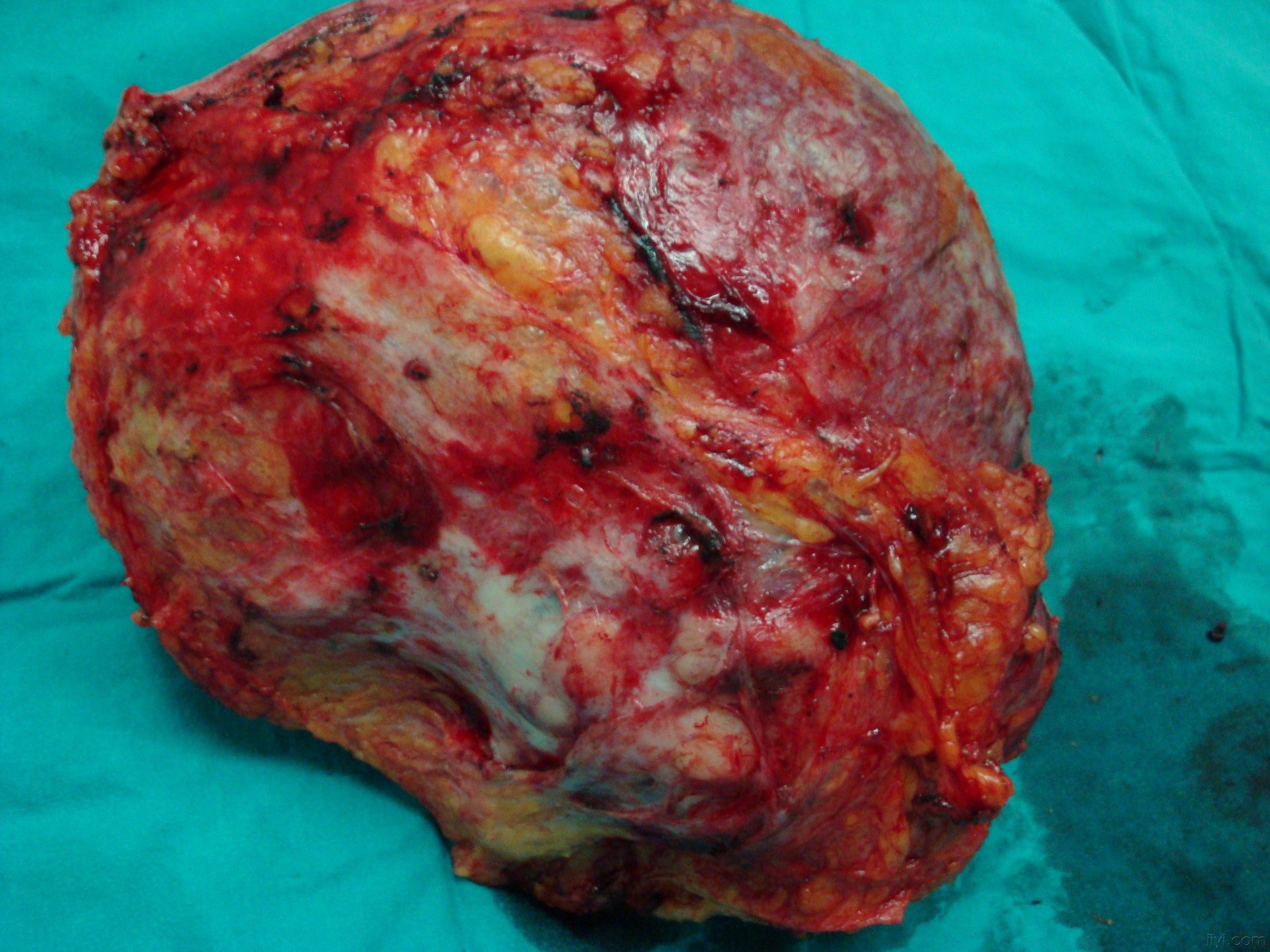 乳腺肿瘤外观图片图片