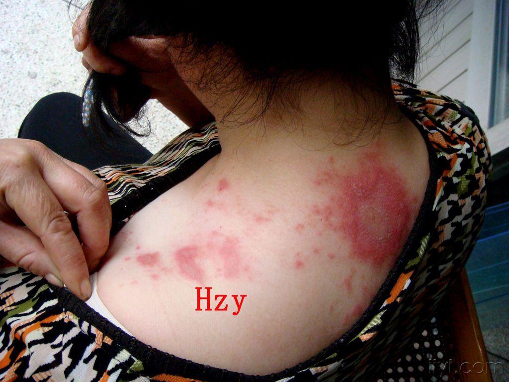 肩背部皮损三天