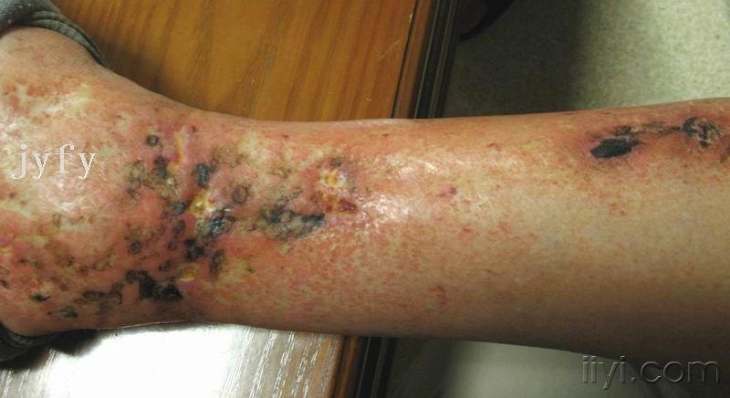 阶段性透明性血管炎白色萎缩