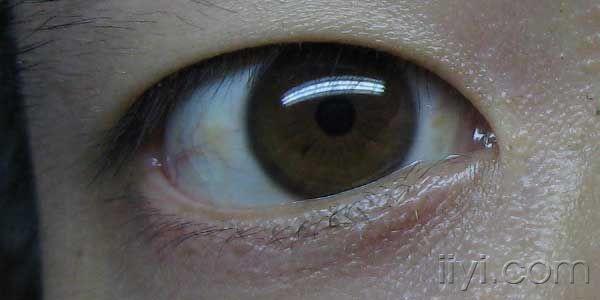 眼睛黄斑病人图片图片