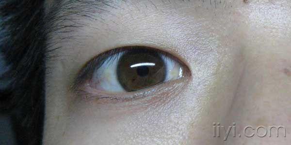 我的白眼球上有黄斑还有一点变色了