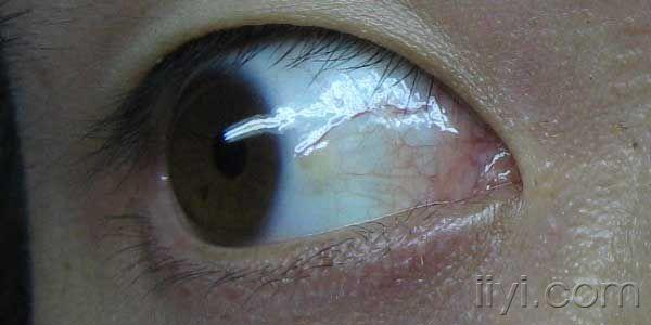 眼球有黄斑怎么治疗图片
