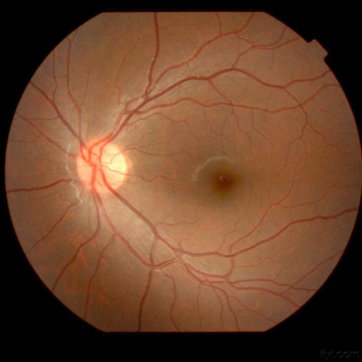15岁男孩网脱附眼底彩照5幅