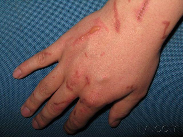 双手多发水疱瘢痕半年余