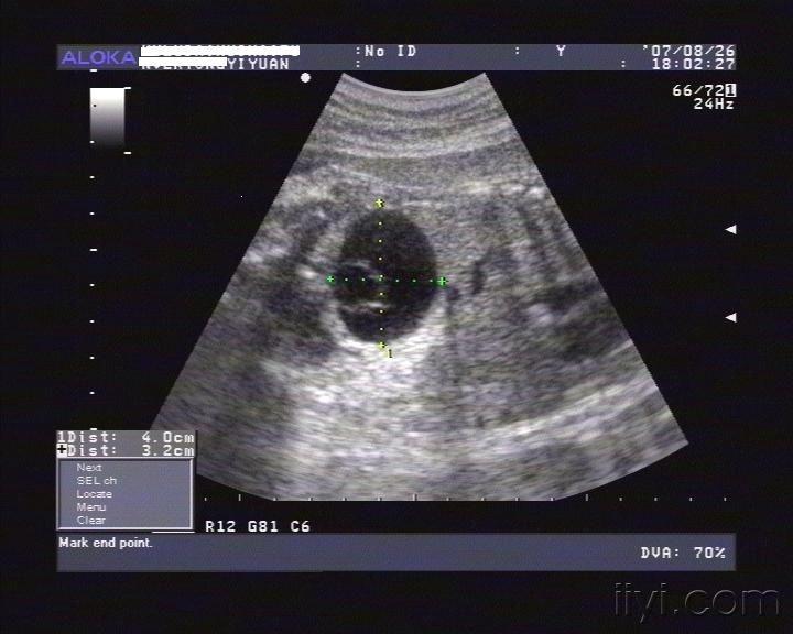 胎儿腹腔囊肿图片