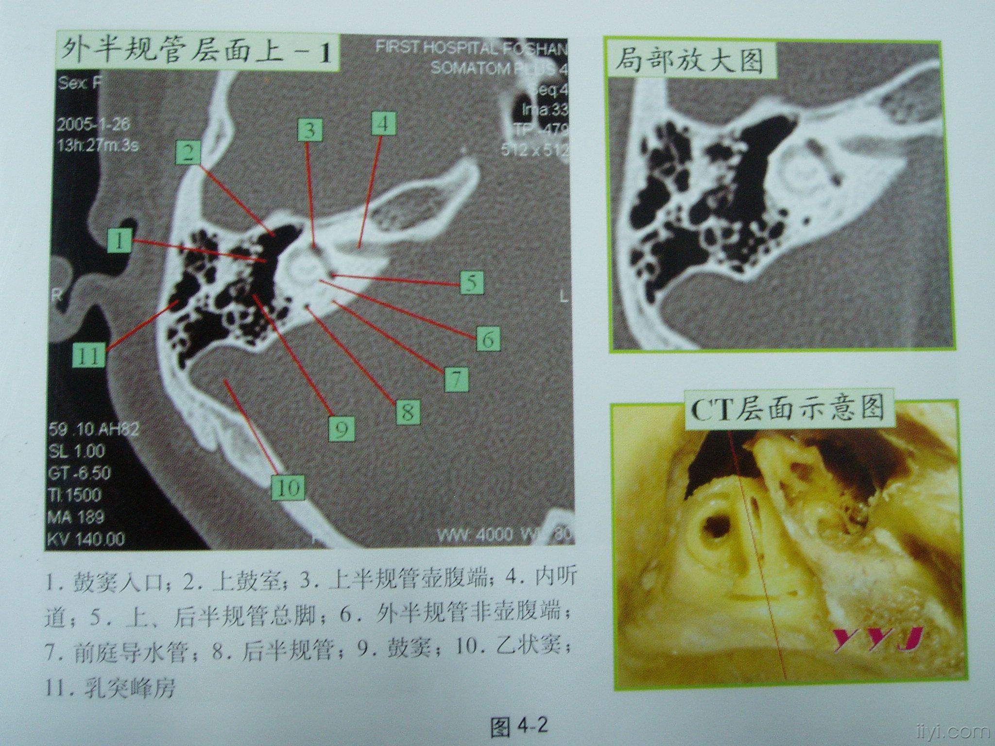 鼓室CT图图片