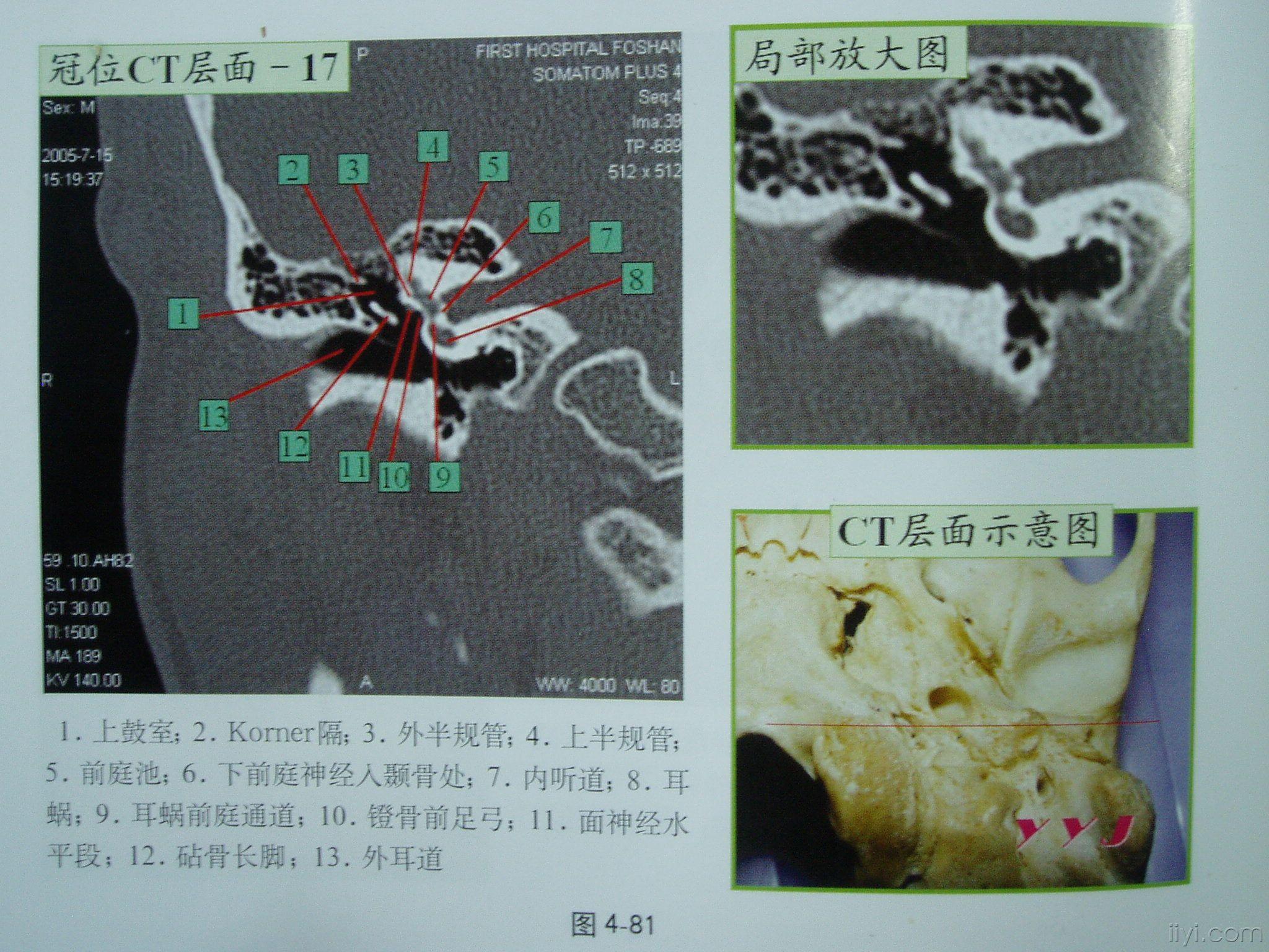 耳部正常ct(冠位 轴位)