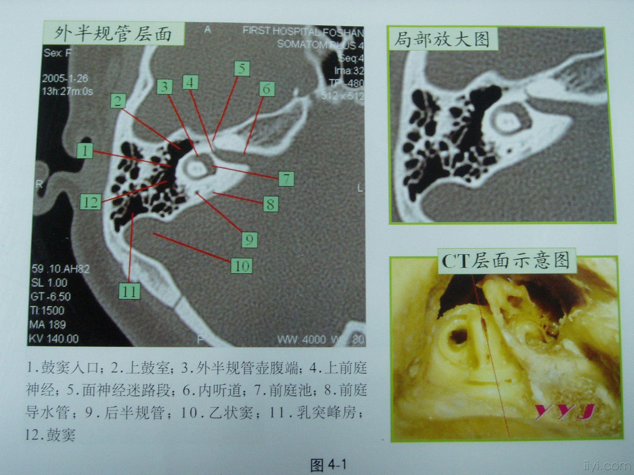 新手看耳部ct片图解图片