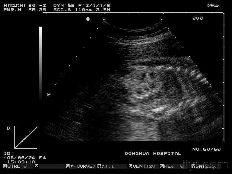 胎儿多囊肾?