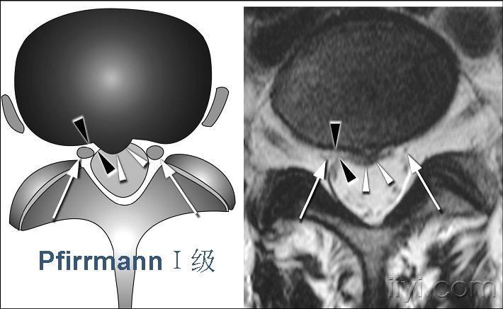 pfirrmann i级 突出间盘与神经跟无接触