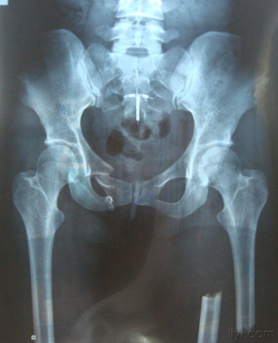 【病例讨论】股骨中上段骨折并另侧耻骨上下支骨折