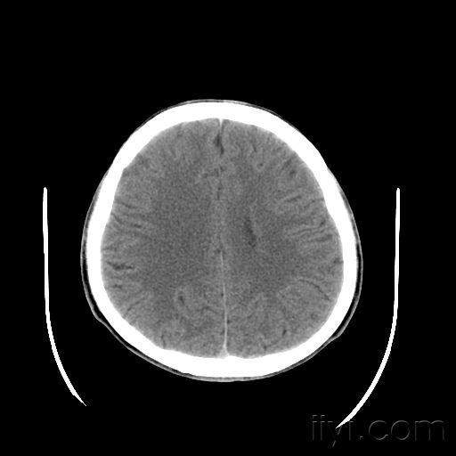 灰质异位症室管膜下型