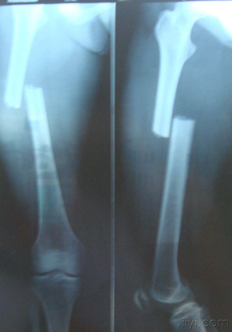 【病例讨论】股骨中上段骨折并另侧耻骨上下支骨折