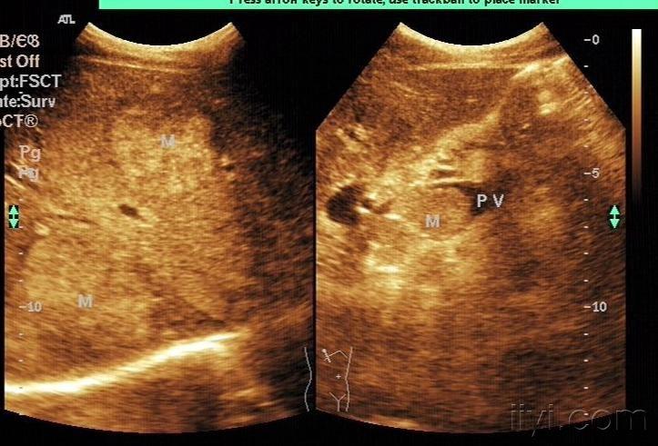肝臟多發性實質性佔位病變考慮為轉移性肝ca門靜脈癌栓