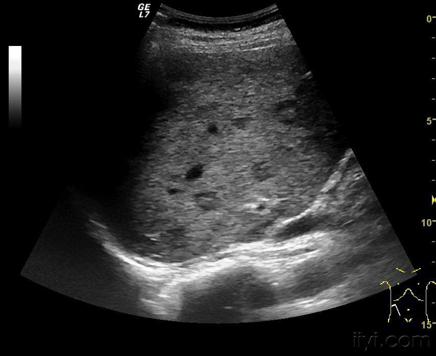 牛眼征! - 超声医学讨论版 - 爱爱医医学论坛