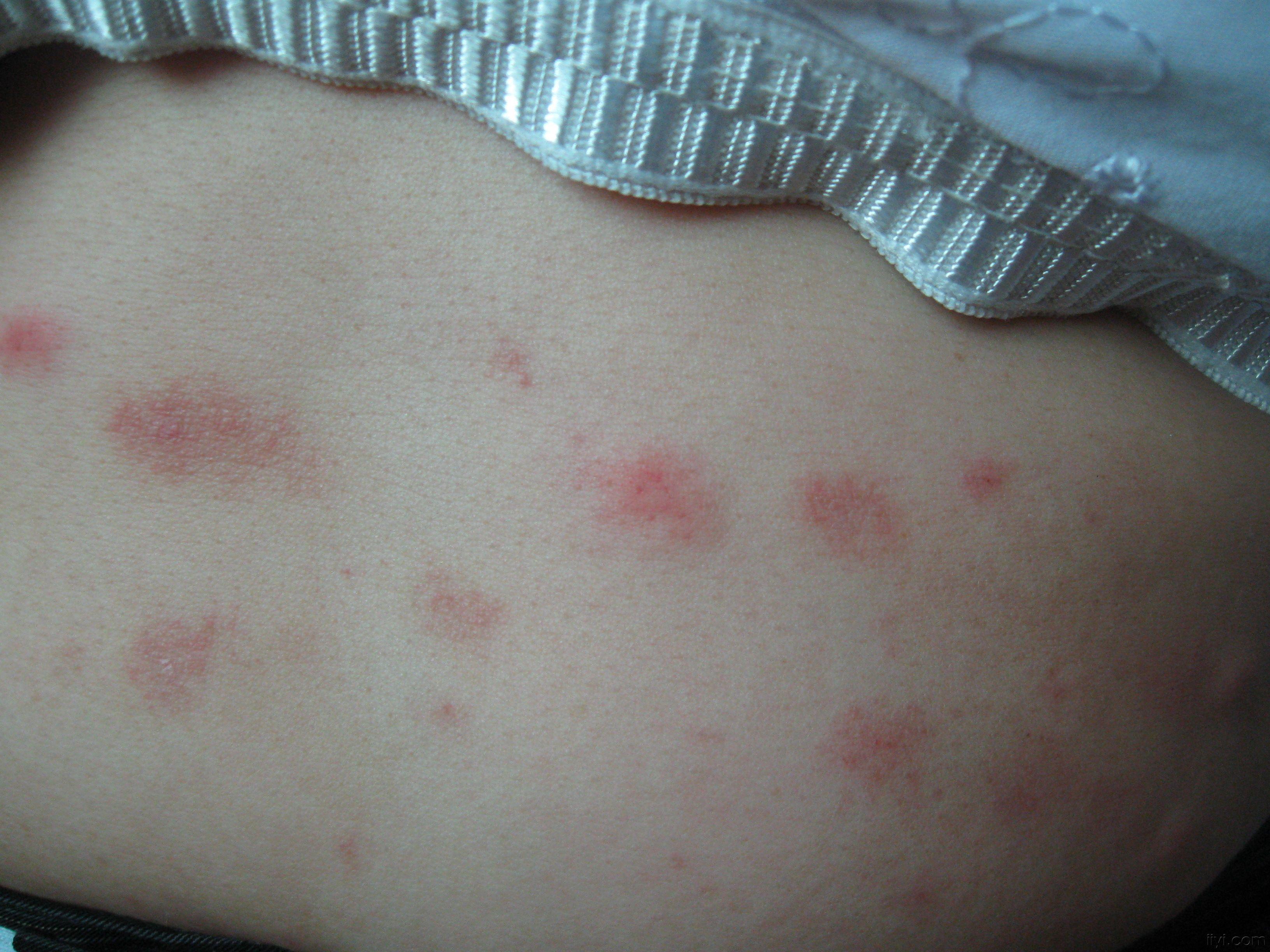 丘疹性荨麻疹症状图片