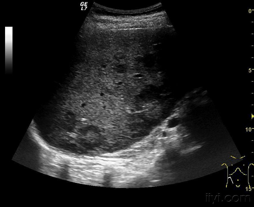 牛眼征! - 超声医学讨论版 - 爱爱医医学论坛