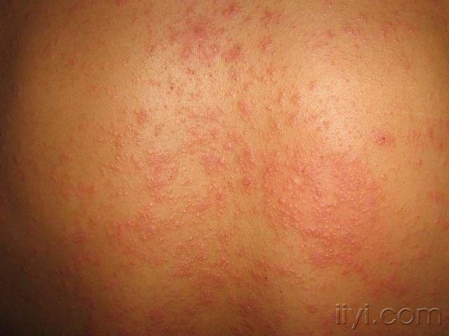 丘疹性玫瑰糠疹
