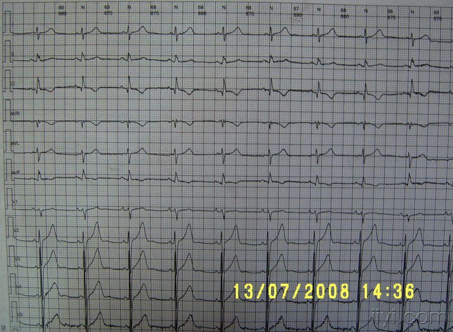 肺型p波图片