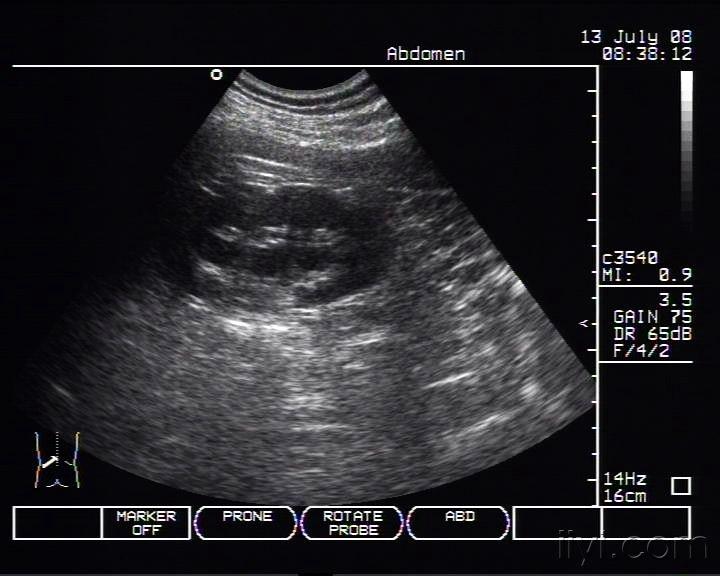 肾积水? - 超声医学讨论版 - 爱爱医医学论坛