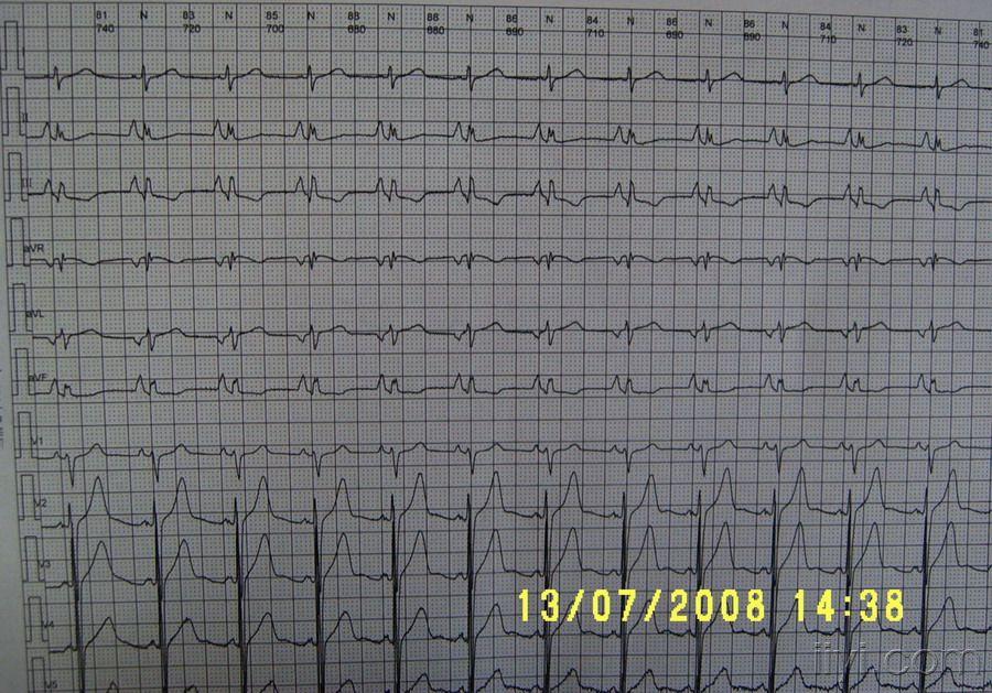 交感性肺型p波? - 心电图脑电图专业讨论版 - 爱爱医医学论坛