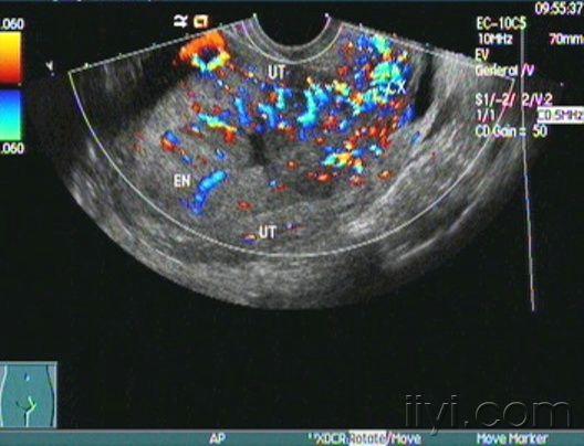 子宮內膜病變聲像圖