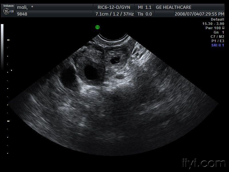 分享宫外孕,黄体同侧出现 - 超声医学讨论版 - 爱爱医医学论坛