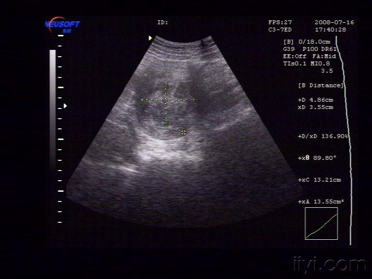 子宫腔内低回声占位,考虑什么