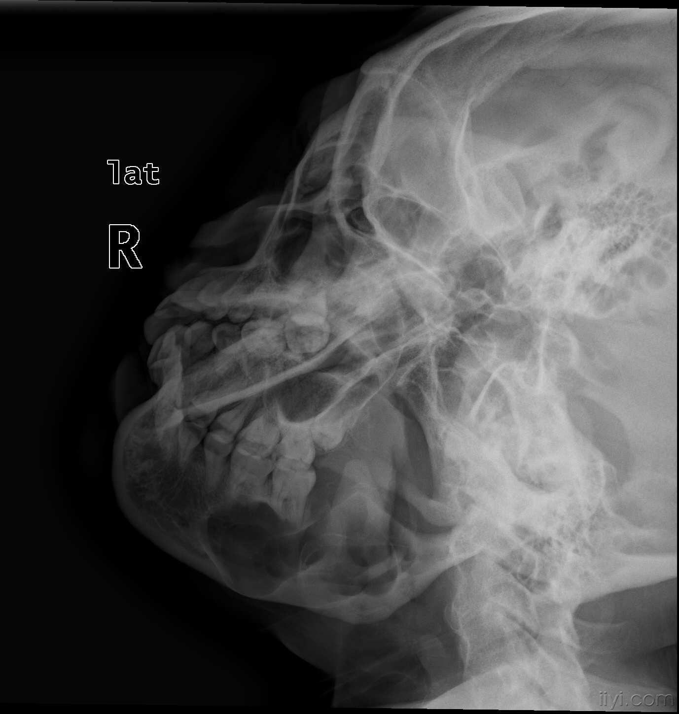 我在放射科学习期间收藏的典型骨骼疾病的dr片,图片超级多,超清晰,很