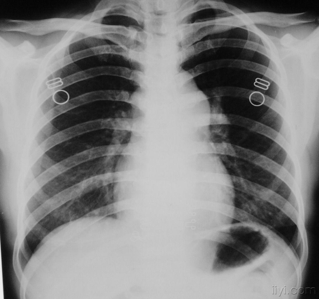 肺动脉段病变有结果感兴趣的看看