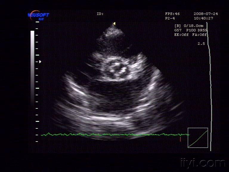 主动脉瓣狭窄,二尖瓣前叶脱垂等等 超声医学讨论版 爱爱医医学