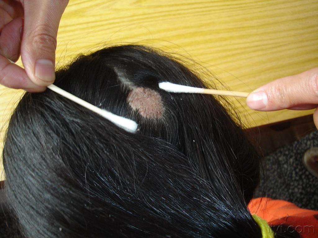 头部皮损十七年