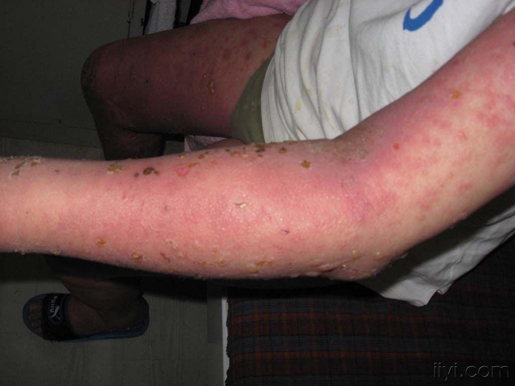 昨天门诊以疱疹样皮炎收入院新上治疗一周后的照片