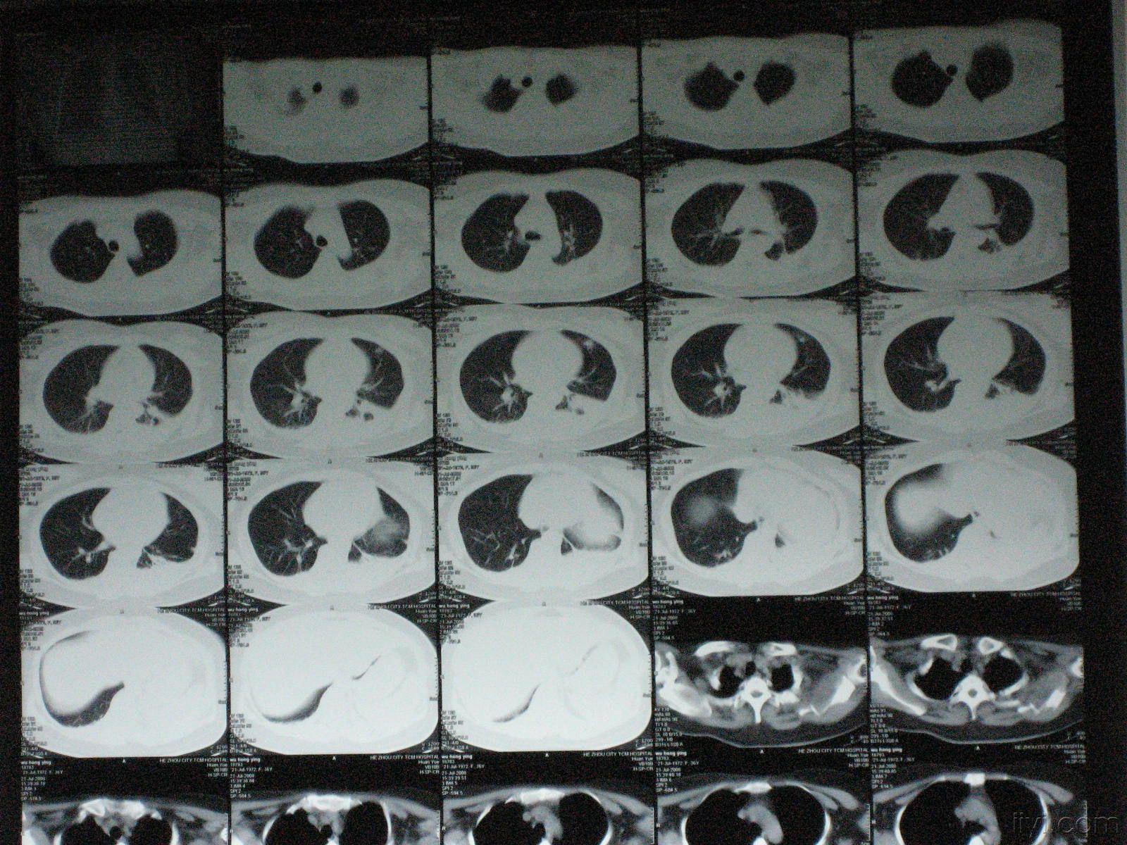 求助左下肺不张患者下一步治疗