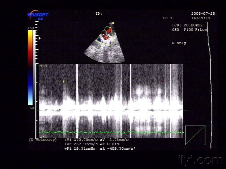 先天性心脏病 :房间隔缺损(ii孔型) - 超声医学讨论版 - 爱爱医医学