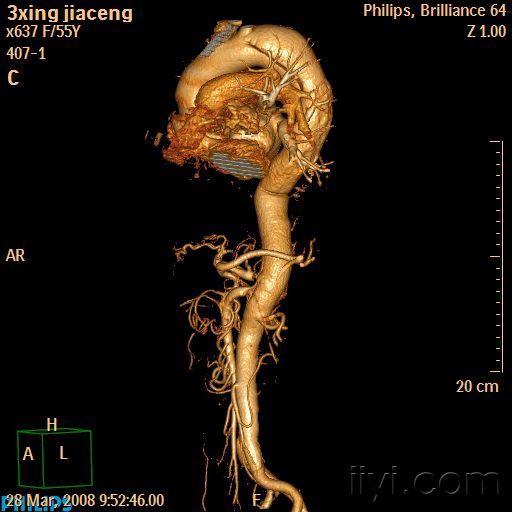 主动脉cta解剖图图片