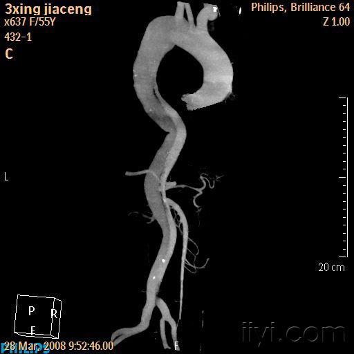 主动脉CTA图片