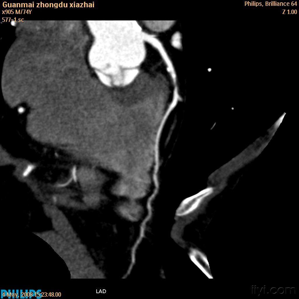 冠脈cta冠脈重度狹窄欣賞