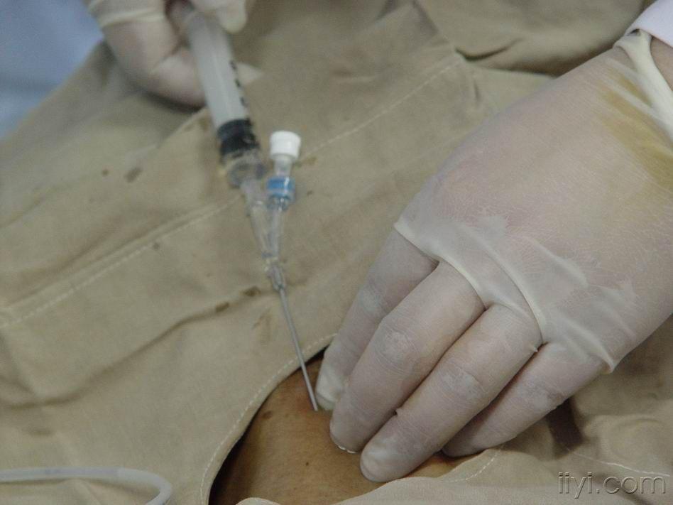 中心静脉穿刺置管术