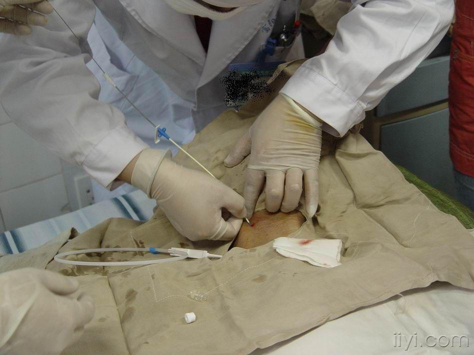 中心静脉穿刺置管术