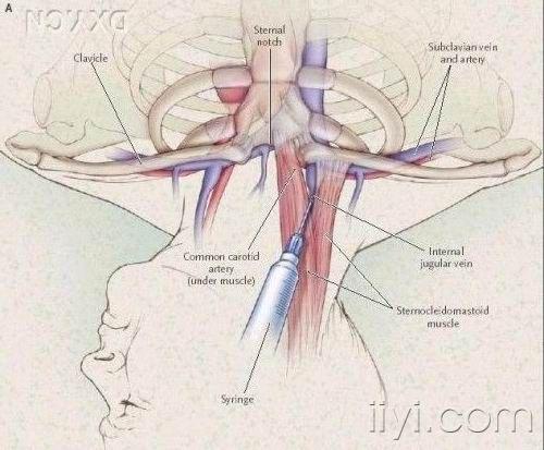 颈内静脉穿刺置管深度图片