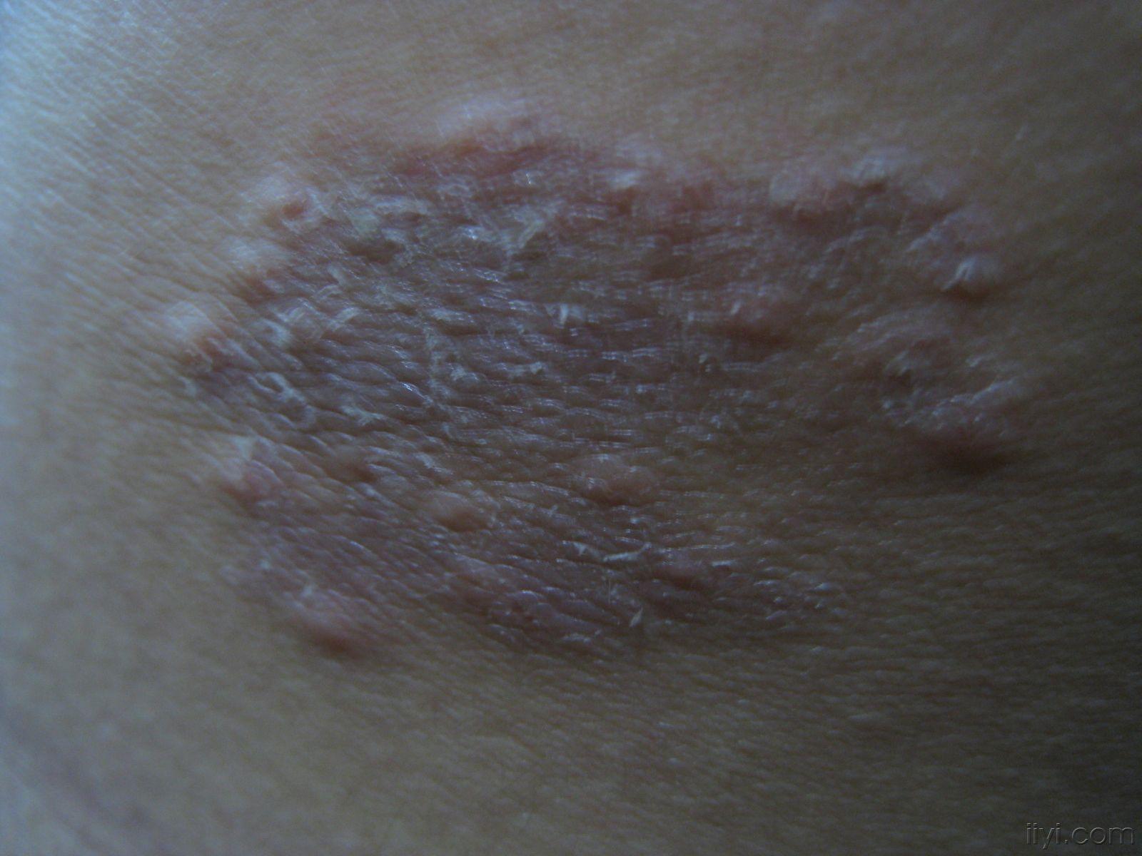 湿疹梅花斑癣图片图片