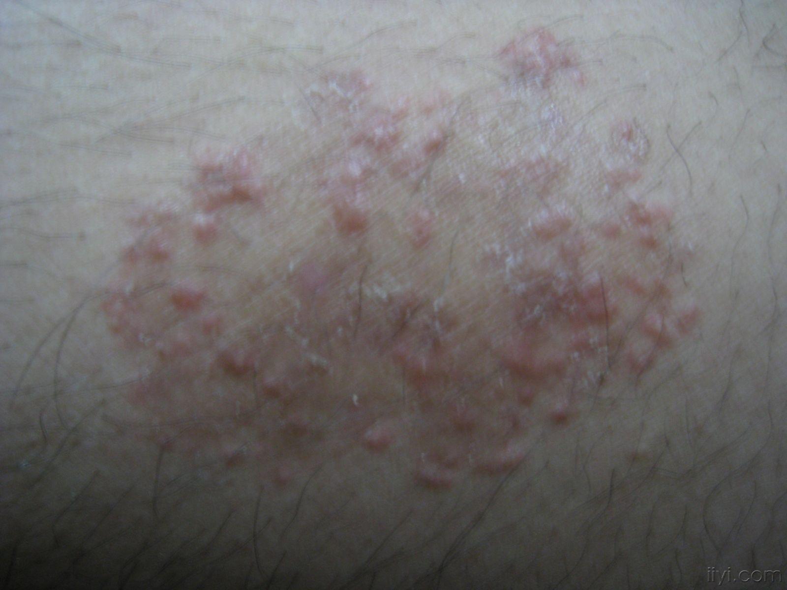 摩擦性苔藓样疹-常见皮肤病-医学