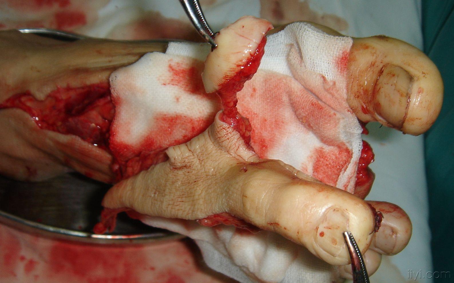 显微手足外科再造术